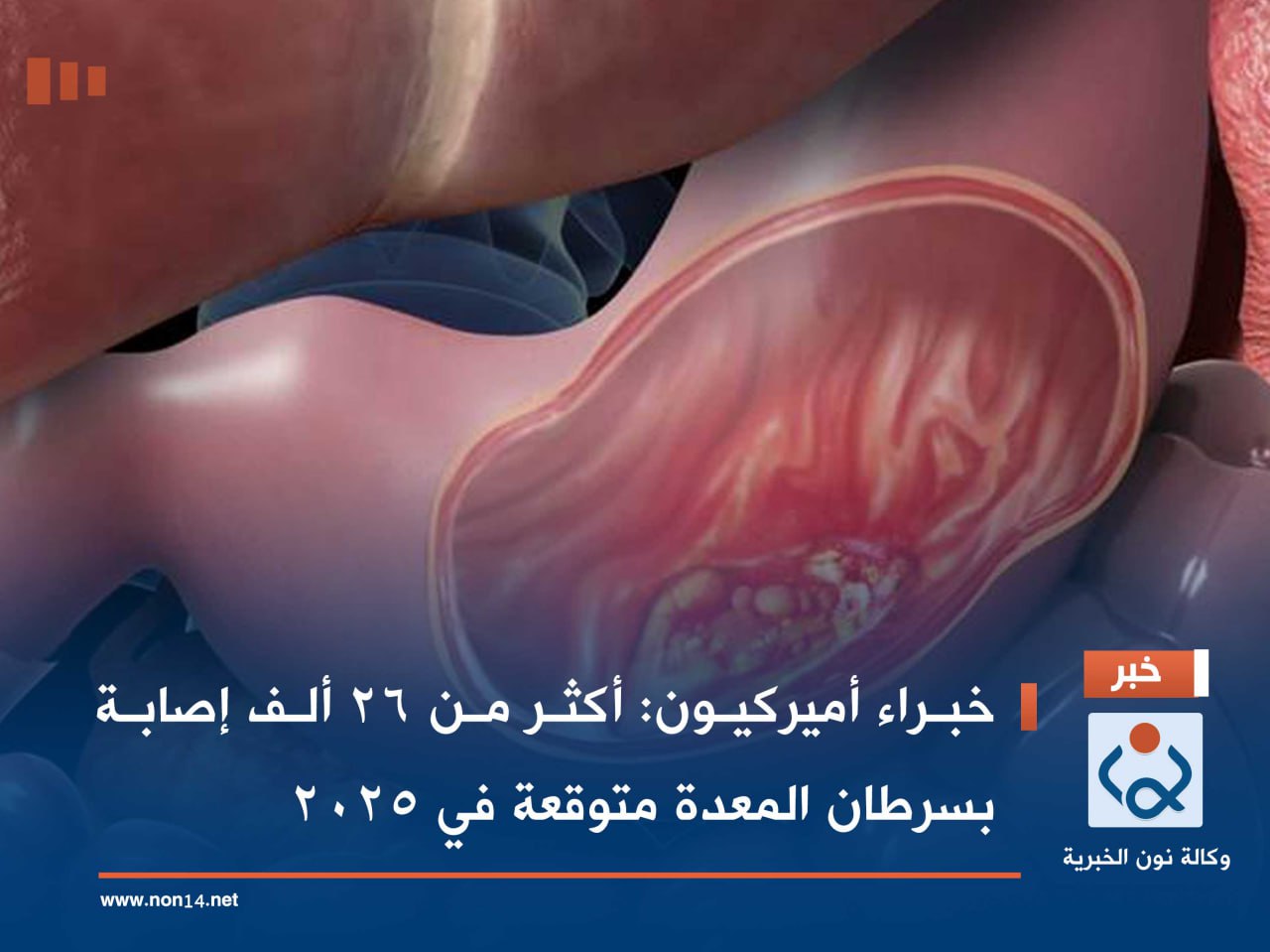 خبراء أميركيون: أكثر من 26 ألف إصابة بسرطان المعدة متوقعة في 2025