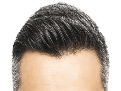 ما هي أسباب ظهور الشيب المبكر؟