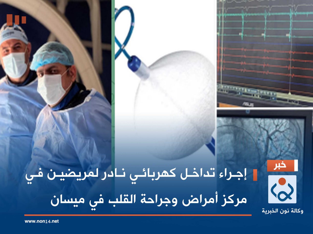 إجراء تداخل كهربائي نادر لمريضين في مركز أمراض وجراحة القلب في ميسان