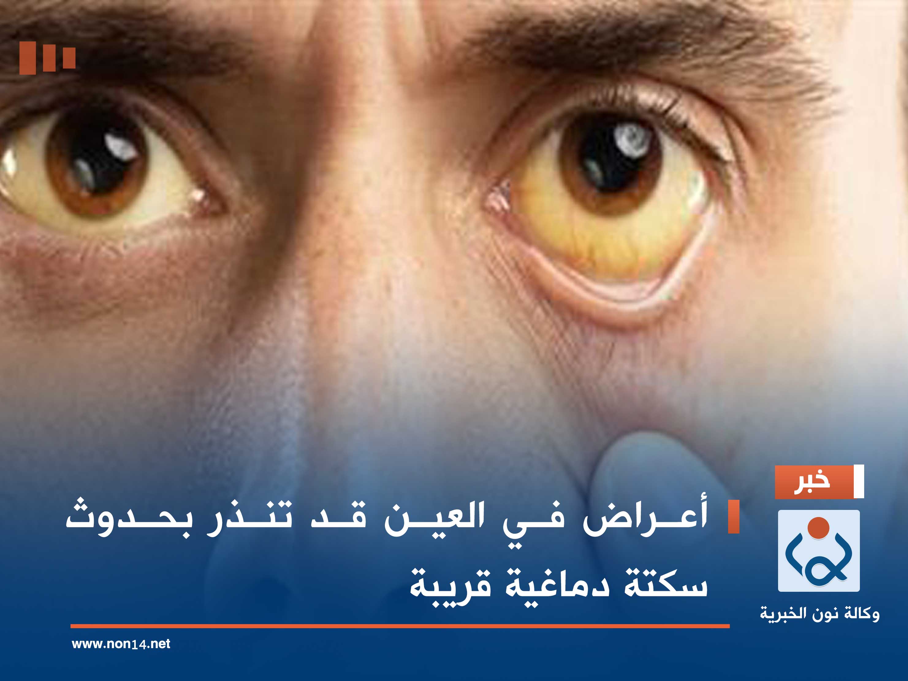 أعراض في العين قد تنذر بحدوث سكتة دماغية قريبة