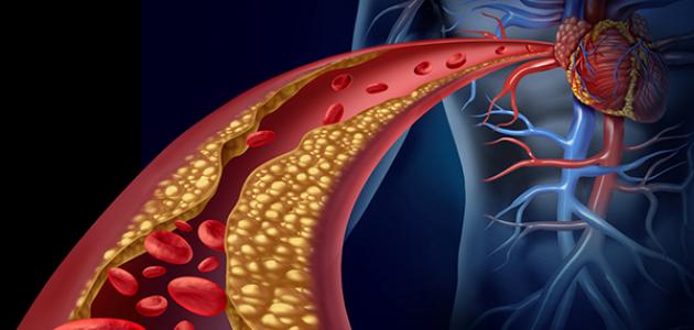 هل تعاني من ارتفاع الكوليسترول؟ إذا تجنب هذه الأطعمة وتناول أخرى !