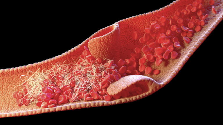 دراسة تحدد سبب تشكّل جلطات الدم لدى المصابين بـ"كورونا" الشديدة