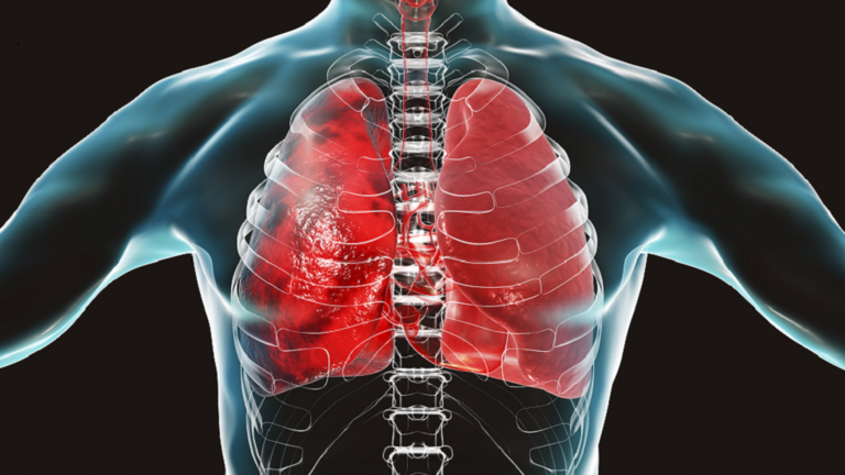 لماذا تؤدي عدوى الرئة قصيرة العمر إلى تلف طويل الأمد ؟
