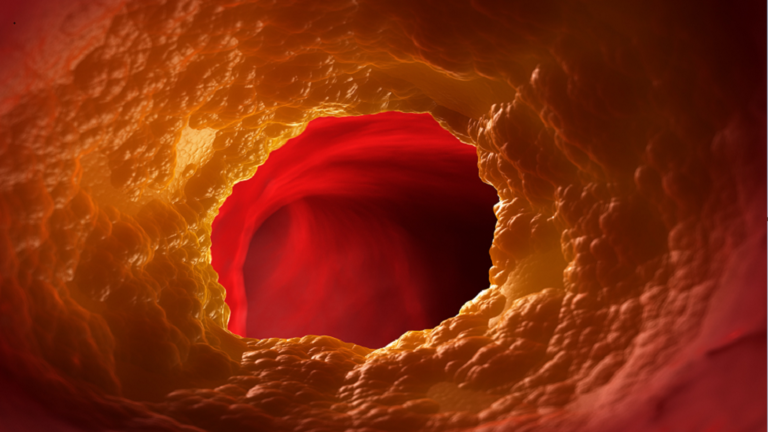 ارتفاع نسبة الكوليسترول.. شعور في ذراعيك قد يدل على انسداد الشرايين !