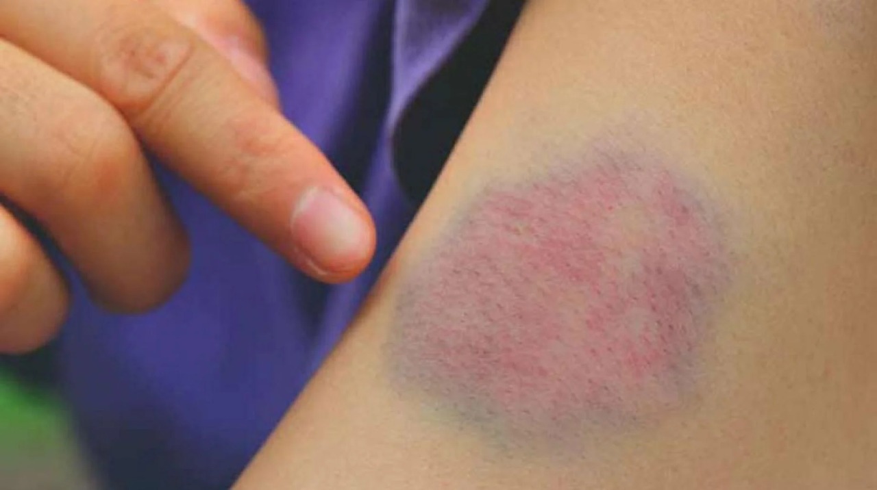 كيف تبدو جلطة الدم ؟ .. كيف تفرق بين الكدمات والجلطات الدموية ؟!