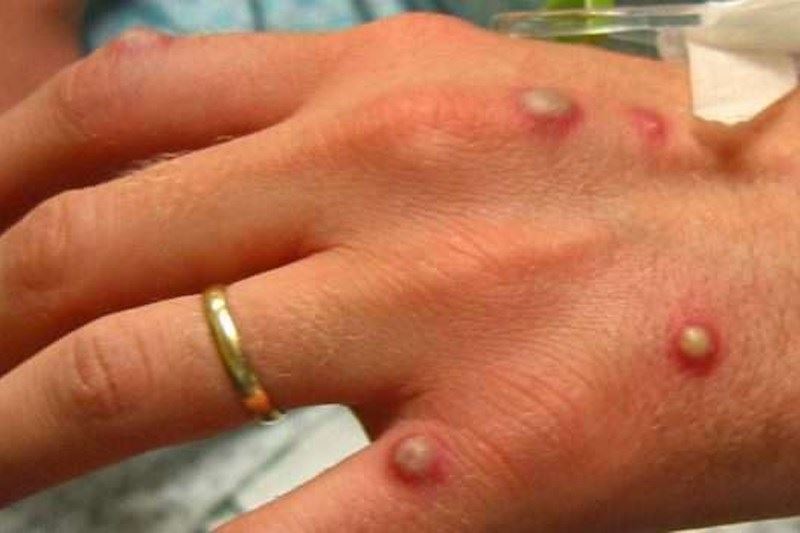 الإمارات تسجل 3 إصابات جديدة بجدري القردة