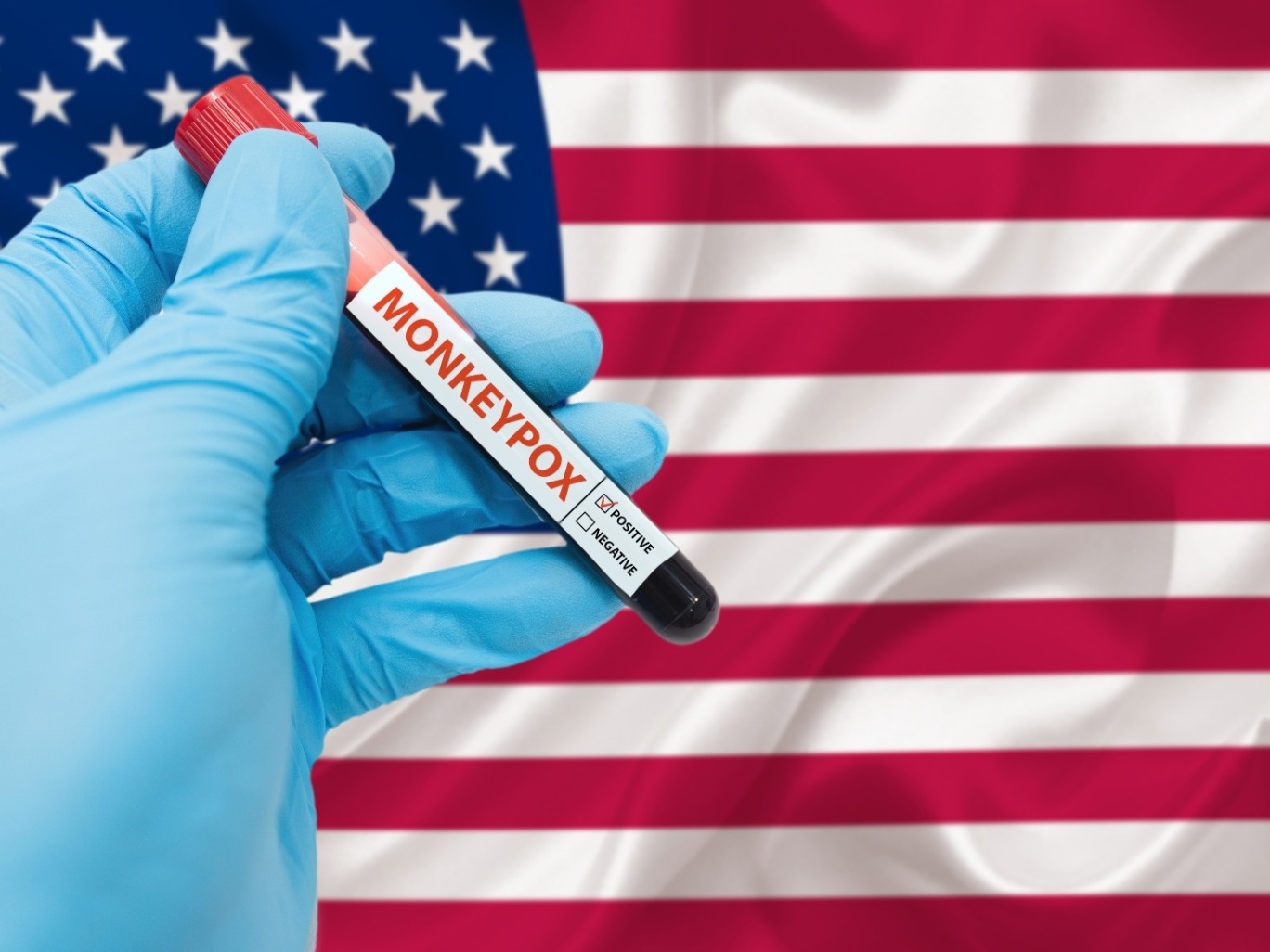 تسجيل أكثر من 13500 إصابة بجدري القردة في أمريكا