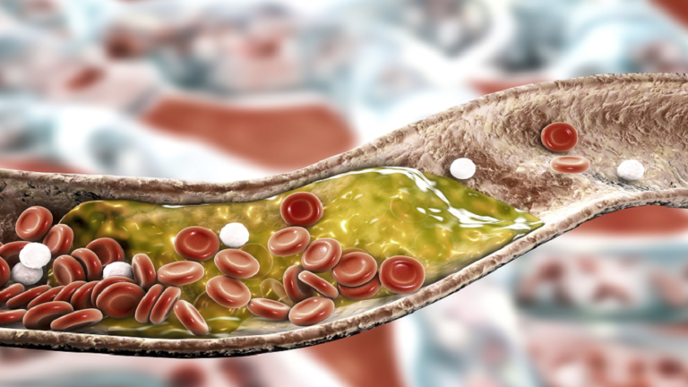 "العلامة الأولى" لارتفاع نسبة الكوليسترول .. "تصيب ساقيك ويمكن أن تكون خطيرة"!