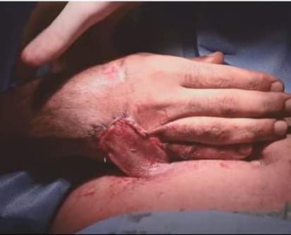 بالصور:جراح كربلائي يزرع يد مُصاب داخل بطنه