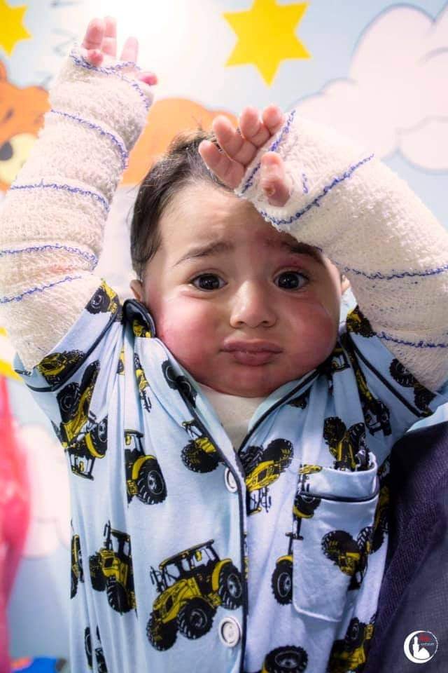 بالصور:طفل صغير بكربلاء يتعرض لحالة حرق نسبتها 25 ٪ والتدخل الطبي ينقذ حياته