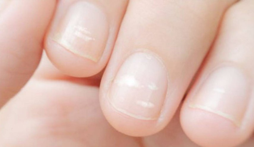 احذر.. البقع البيضاء على الأظافر مؤشر على إصابتك بأمراض خطيرة