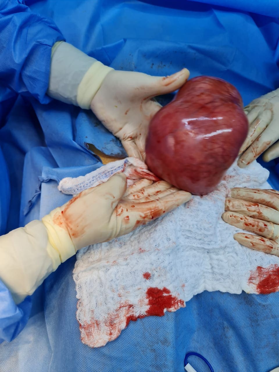 " تُعاني من عُقم أولي " : إستئصال ورم ليفي حجمه  15 سم من رحم عشرينية بكربلاء