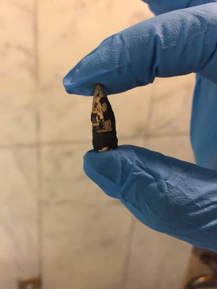 جراح كربلائي يستخرج "رصاصة طائشة " بمناسبة رياضية تستقر في كتف فتاة لمدة (8 ) سنوات