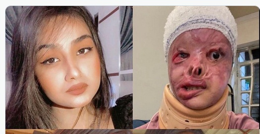 جريمة تشعل غضب العراقيين.. حرق فتاة بالتيزاب ومجلس القضاء يكشف التفاصيل