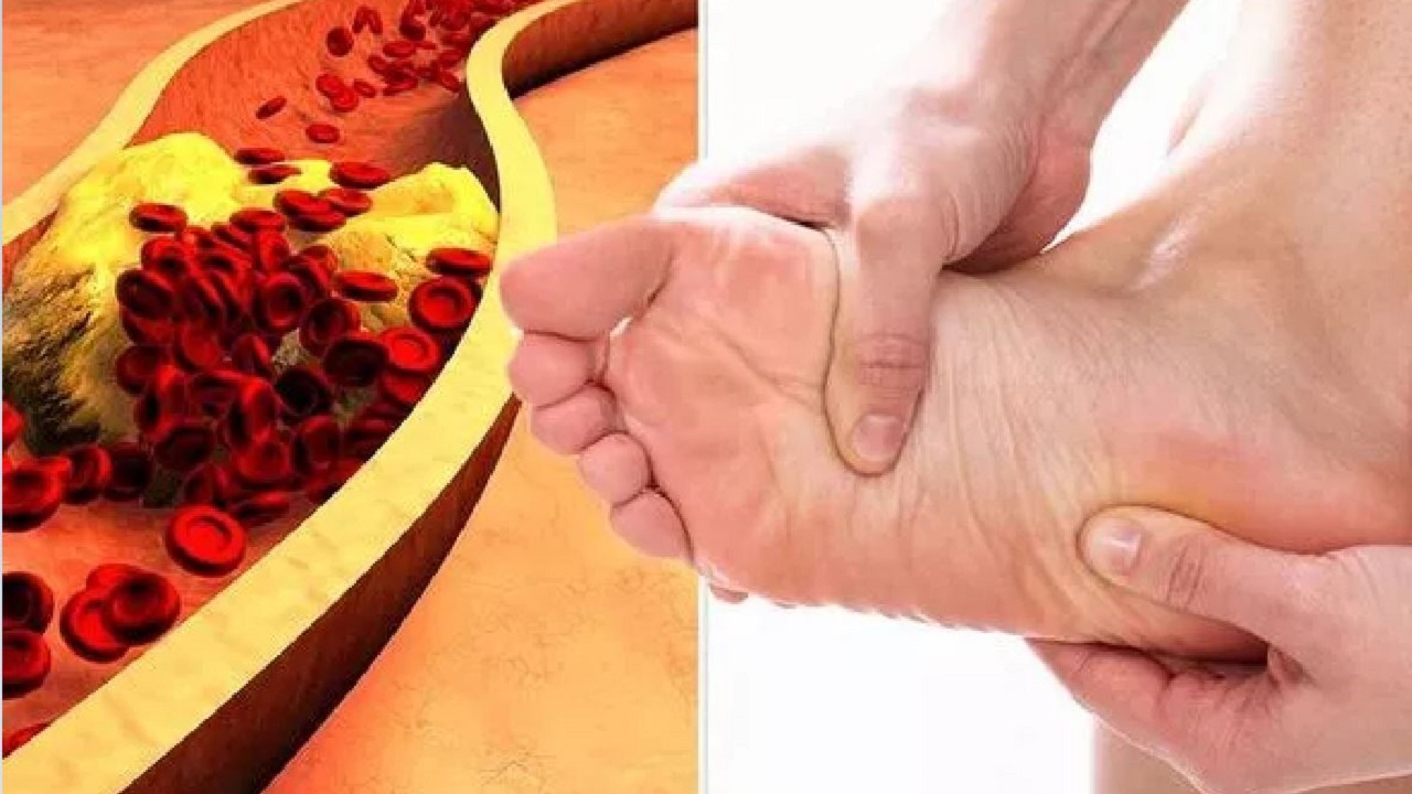 أعراض ارتفاع الكوليسترول في الدم .. علامة خطيرة تظهر في الساقين