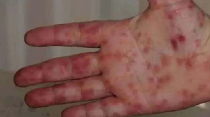 أعراض إنفلونزا الطماطم.. فيروس جديد قادم من الهند