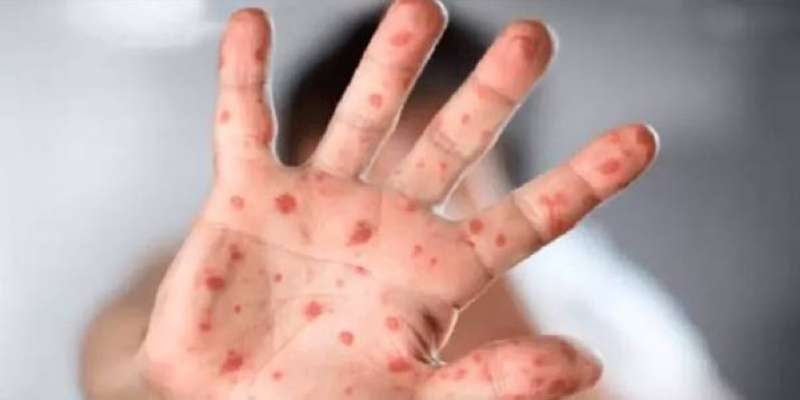 السعودية: رصد إصابة بجدري القرود في الرياض