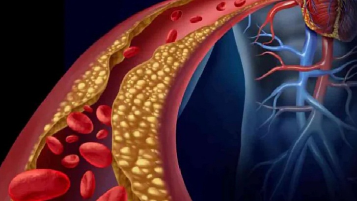 5 علامات على ارتفاع نسبة الكوليسترول في الدم