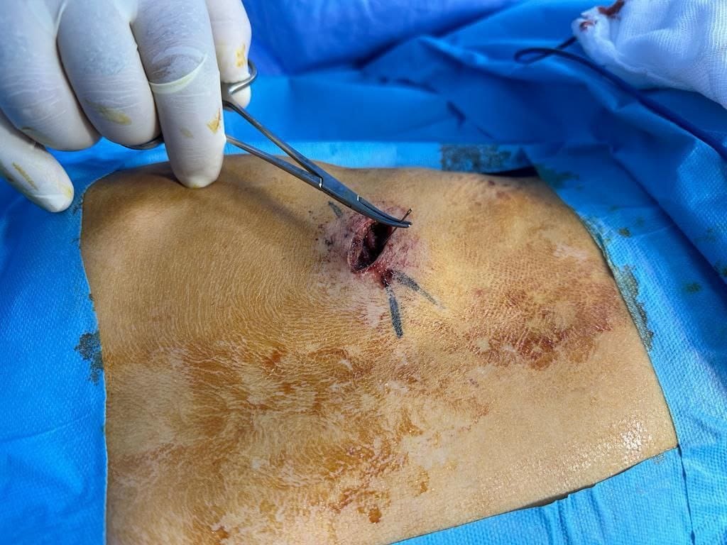 بعمر الـ 9 سنوات .. فريق طبي بكربلاء يستخرج إبرة خياطة مُغروسة في صدره أثناء نومه