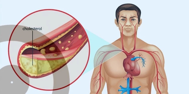 ثلاثة اعراض تؤكد ارتفاع نسبة الكوليسترول في جسمك