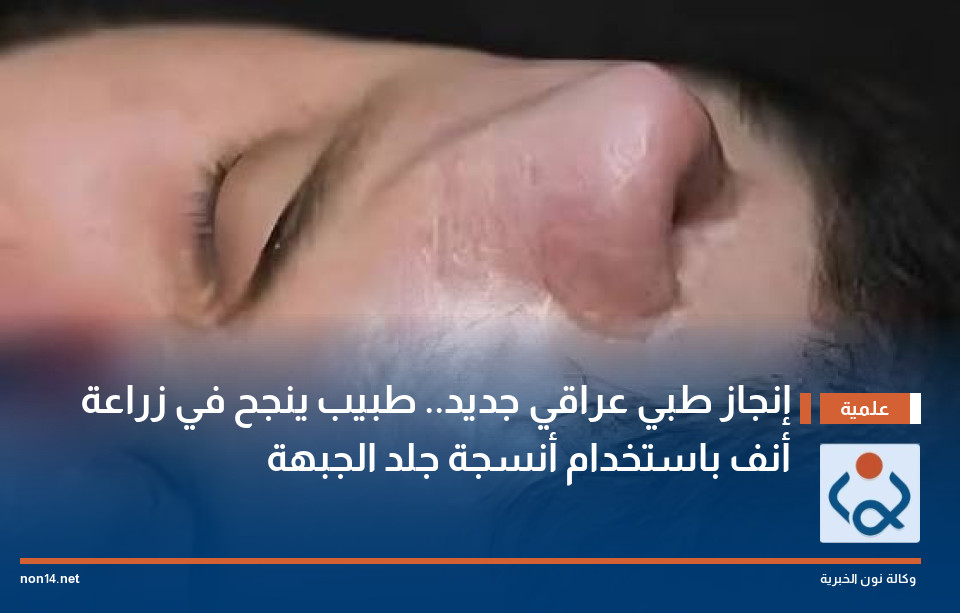 إنجاز طبي عراقي جديد.. طبيب ينجح في زراعة أنف باستخدام أنسجة جلد الجبهة
