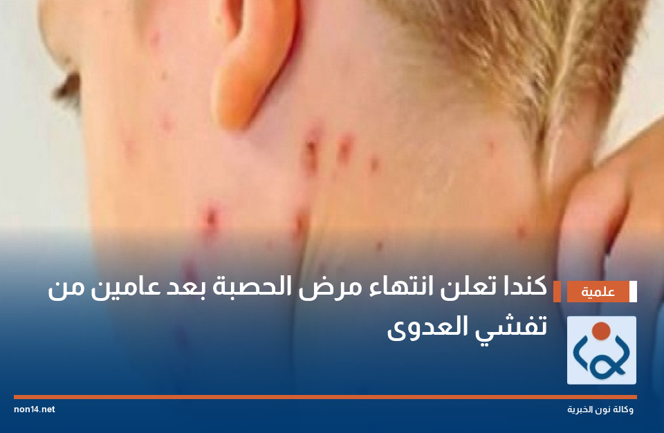 كندا تعلن انتهاء مرض الحصبة بعد عامين من تفشي العدوى