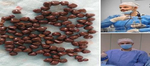 استخراج اكثر من 100 حصاة من كلية مريض في مستشفى النجف الأشرف