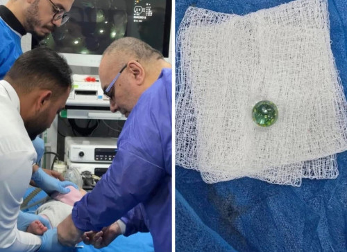 علقت في المريء.. انقاذ حياة طفل عمره سنة واحدة ابتلع “كرة زجاجية