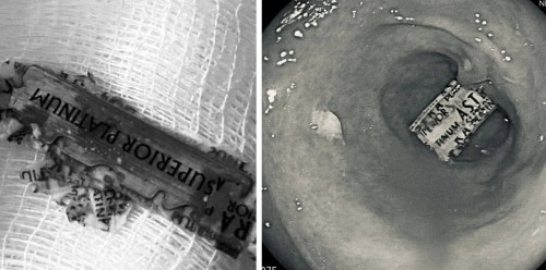 استخراج “موس حلاقة” من معدة مريض في بغداد