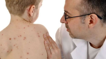 صحة أربيل تسجل 39 إصابة بالحصبة بين الأطفال وتطلق حملة تطعيم لمكافحة الفيروس